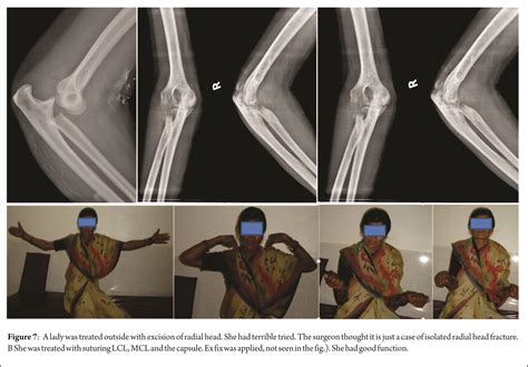 Terrible Triad Is No More Terrible Journal Of Clinical Orthopaedics
