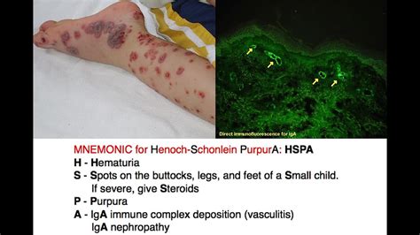 Henoch Schonlein Purpura Hsp [mnemonic] Youtube