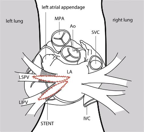 Figure 2 From Pulmonary Vein Widening Plasty For Pulmonary Vein Stenosis And Occlusion After