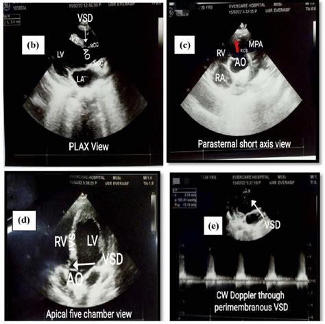 Images A E Represent Preoperative Transthoracic Echocardiographic