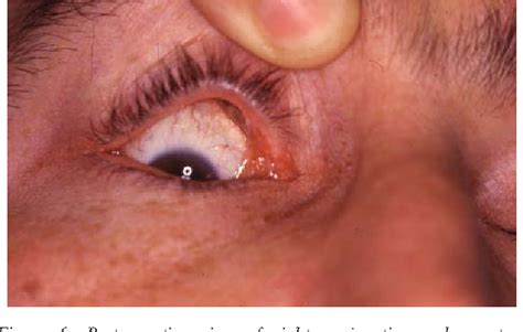 Figure 1 From Primary Amyloidosis Of The Eyelid A Case Report Semantic Scholar