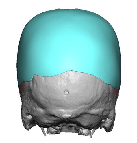 Plastic Surgery Case Study Custom Two Piece Skull Implant For Adult