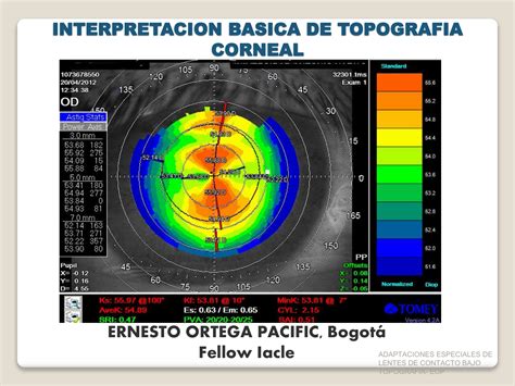 Interpretación de la topografía corneal