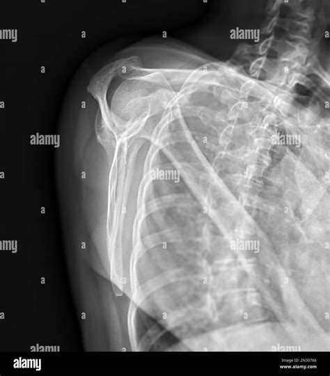 X Ray Shoulder Joint Shoulder Transcapular View For Diagnosis Fracture