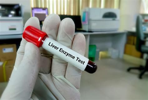 Premium Photo | Blood sample for liver enzyme test