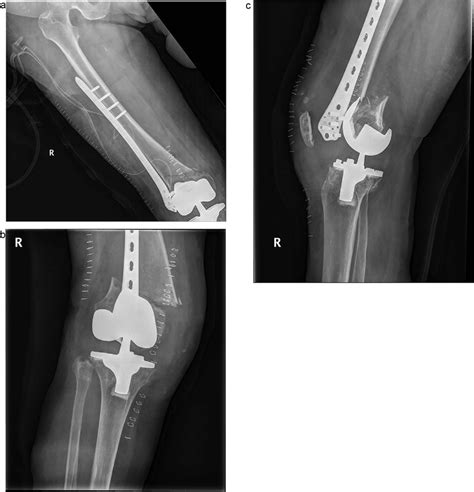 A Postoperative Radiography Showed A Reduction Of Displaced Fracture