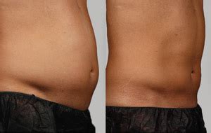 Laser Lipo Before After Lightrx Medspa