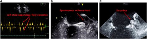 Frontiers Left Atrial Cardiomyopathy A Challenging Diagnosis