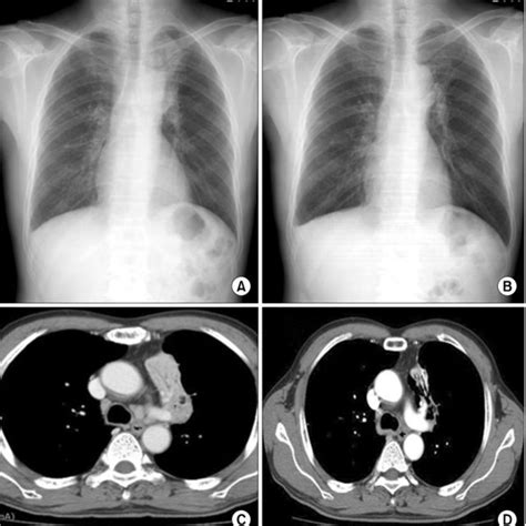 Chest X Ray And Chest Computed Tomography Ct Image A At Admission Download Scientific