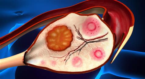 Acanthamoeba Keratitis Causes Symptoms Treatment And Precautions Dhir Hospital