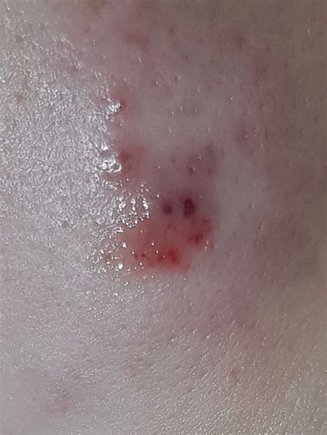 I Had This Pimple For 3 Weeks And Now I Popped It What Do I Do Now Does It Look Infected I