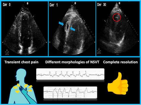 Figure From Interventricular Septal Hematoma Complicating Left Bundle