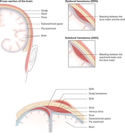 Craniocerebral Trauma Clinical Tree