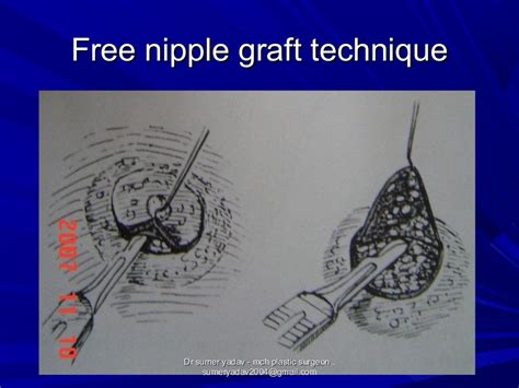 Reduction Mammoplasty