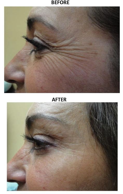 Before And After Botox® Photos Page 2 Of 18 The Medical Spa