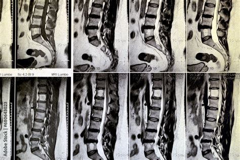 Mri Lumbosacral Spine Without Contrast Revealed Back Muscle Spasm Mild