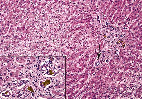 Pathology Of Liver And Hematopoietic Stem Cell Transplantation