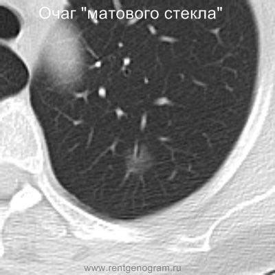 Очаги в лёгких - RENTGENOGRAM