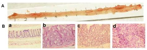 Histopathology Of Azoxymethane Aom Dextran Sodium Sulfate