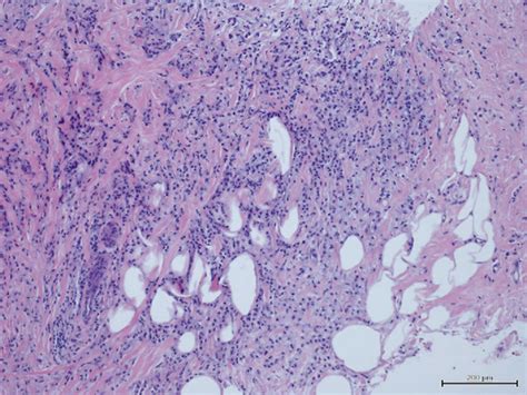 Right Breast Lesion Biopsy Showing Invasive Lobular Carcinoma Arranged Download Scientific