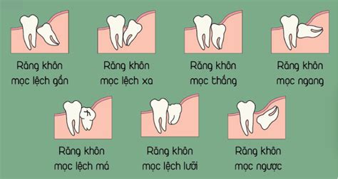 NHƯỢC ĐIỂM CỦA RĂNG KHÔN KHI NÀO NÊN NHỔ BUH