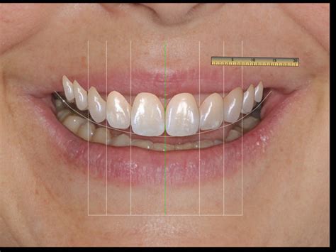 Dise O Digital De La Sonrisa Laboratorio Dental Design