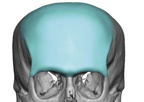 Male Custom Forehead Brow Bone Implant Design Front View Dr Barry Eppley Indianapolis Explore