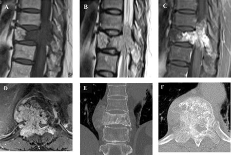 A Preoperative Right Sagittal T1 Weighted Magnetic Resonance Mr Download Scientific