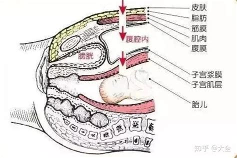 顺产侧切和剖腹产都是挨一刀哪个伤害小 知乎