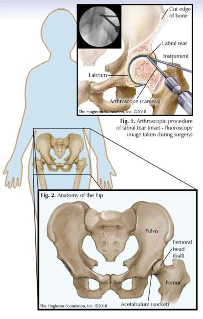 Torn Hip Ligament Surgery