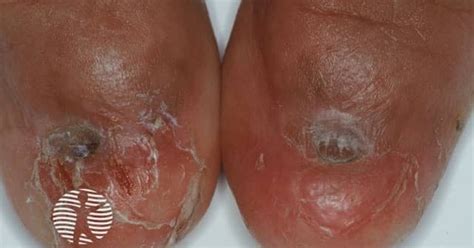 Dermnet Nail Loss Due To Lichen Planus Image