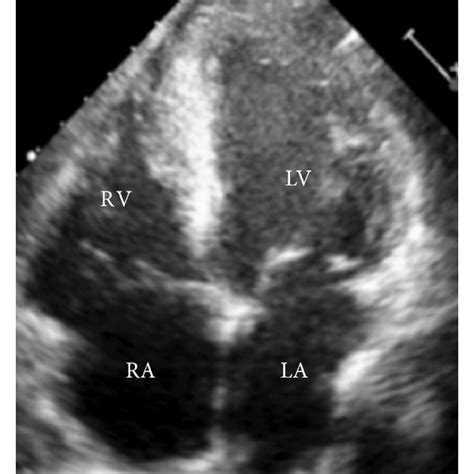 Transthoracic Echocardiogram Apical Four Chamber View A Hospital