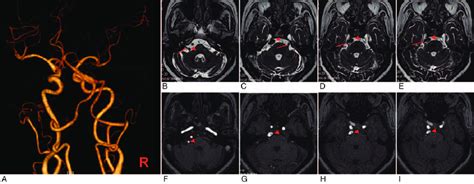 Three Dimensional Volume Rendering Of Cta A Showed Dolichoectasia Of