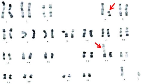 Karyotype Of A Patient With A Balanced Reciprocal Translocation 46 Download Scientific