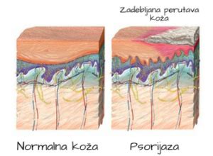 Psorijaza Uzroci I Lije Enje Na Prirodan Na In Ivan Kunje I