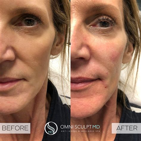 Facial Filler Before After Gallery Omni Sculpt Md