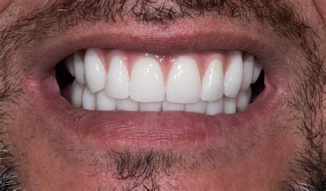 Pembroke Pines Dentist Pembroke Beautiful Smiles Smile Gallery