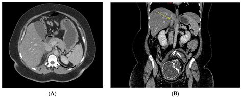 Jcm Free Full Text Adrenal Gland Necrosis In Pregnancy How To