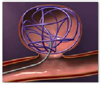 Endovascular Coiling India,Endovascular Coiling Neurosurgery Delhi