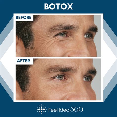 Botox Before And After Man Wrinkles Feel Ideal Med Spa