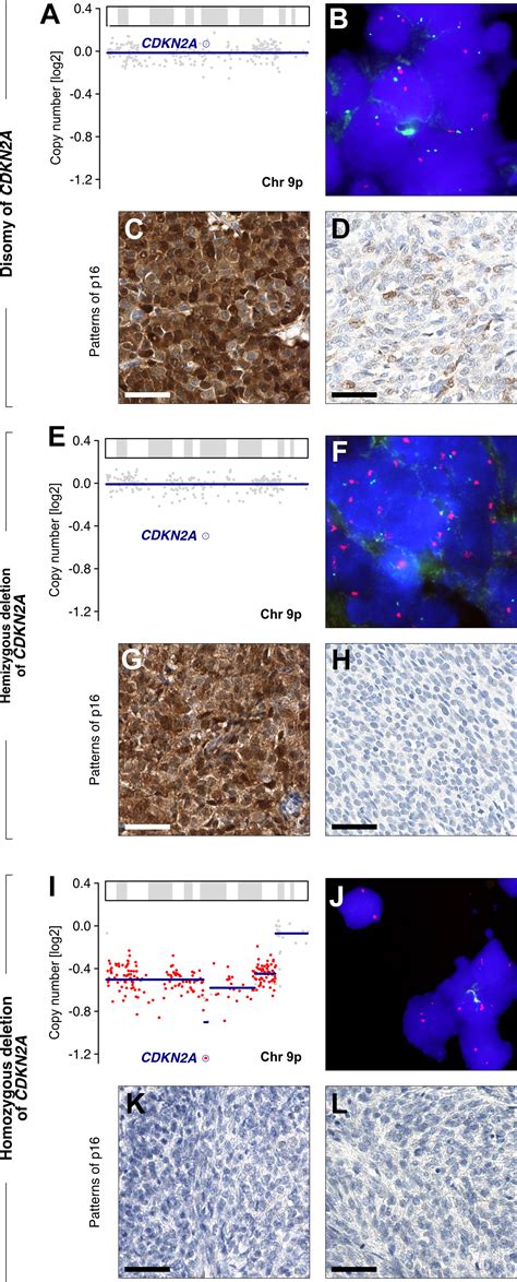 High Grade Endometrial Stromal Sarcomas With Ywhaenutm2 Gene Fusion