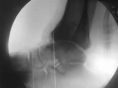 Intraoperative Fluoroscopic View After Osteophyte Resection And Graft