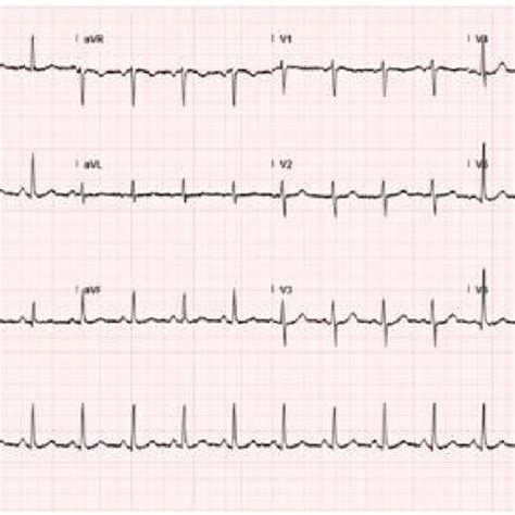 Ecg Of The Same Patient After Resolution Of Svt Showed A Normal Sinus