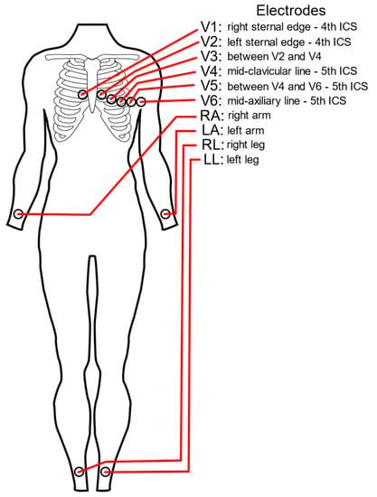 Six Lead Ekg Placement