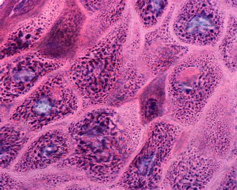 Hyperkeratosis Light Micrograph Stock Image C040 6793 Science