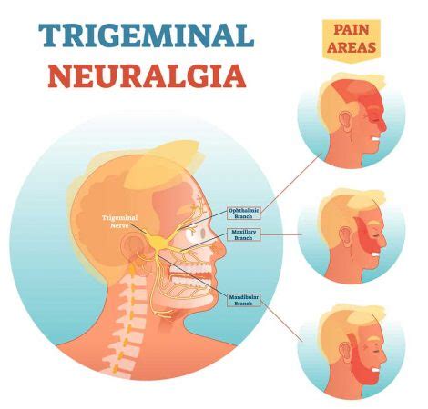 Trigeminal Neuralgia & Metallic Taste | MetaQil