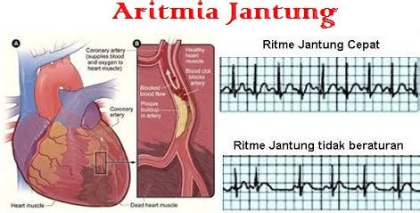 Sehat Alami Walatra Obat Alami Aritmia Jantung Terbaik Masa Kini