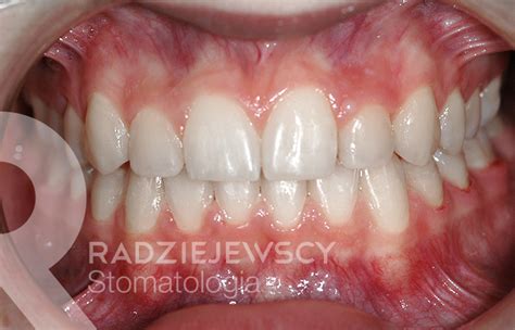 Metamorfozy Stomatologia Radziejewscy Ortodoncja I Nak Adki Invisalign