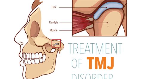 2020 Guide To Tmj Temporomandibular Joint Disorders Smile Angels Of