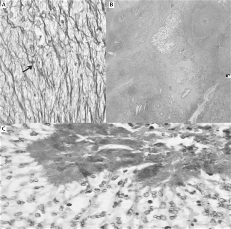 The Biopsy Showed Multiple Branching Filamentous Gram Positive Rods